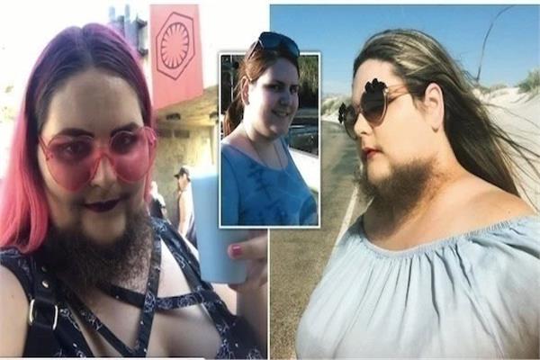 امرأة بريطانية تعاني حالة نادرة تسبب لها نمو لحية طويلة