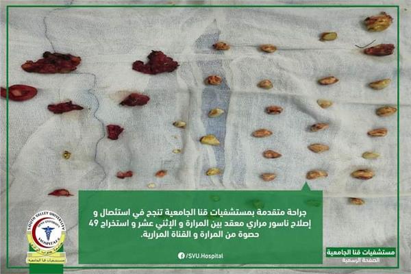 استخراج ٤٩ حصوة من القناة المرارية لمريضة