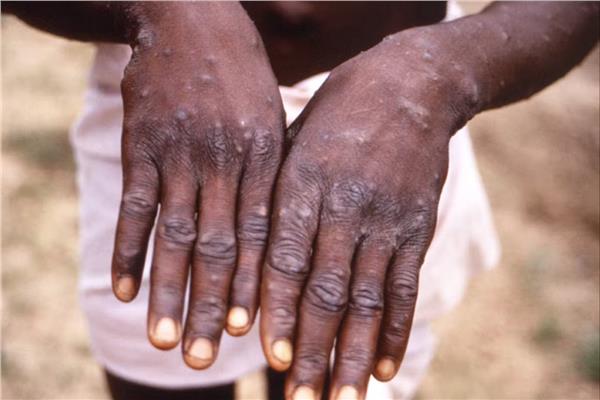 حملة لمواجهة جدري القرود في السودان