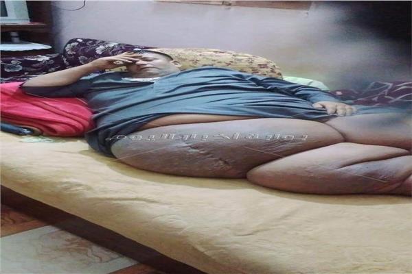 مأساة شاب بالغربية  يعاني من السمنة المفرطة 360 كيلو