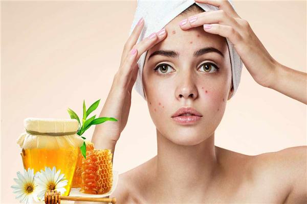 قناع العسل والقرفة لعلاج البثور