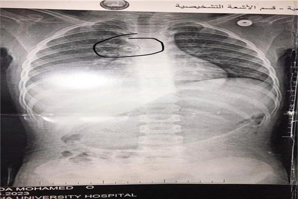 الأشعة الخاصة بالطفلة