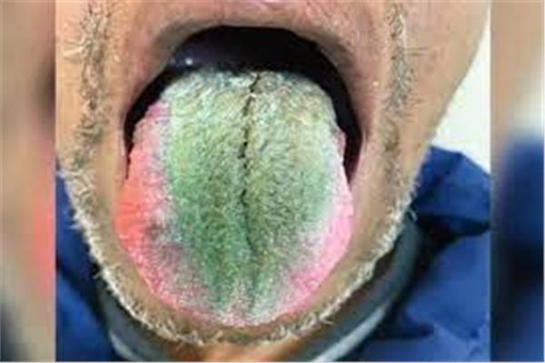 لسان رجل يتحول إلى الأخضر