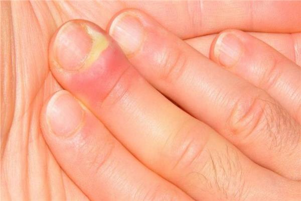 اسباب ينبغى عليك عدم تجاهلها منها تورم أصابع اليدين