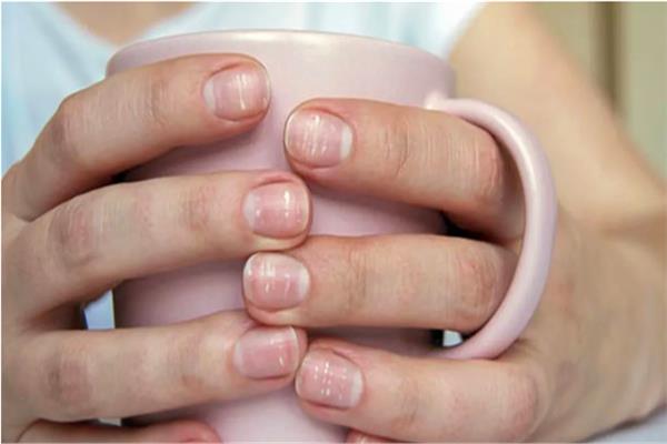 أسباب ظهور النقط البيضاء على أظافرك