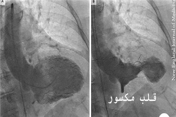 متلازمة القلب المكسور