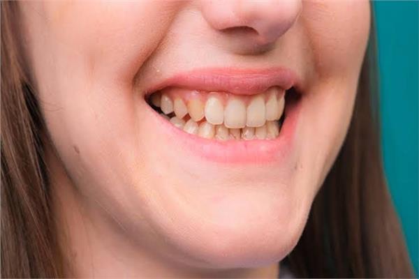 موضوعية_الأسنان الصفراء
