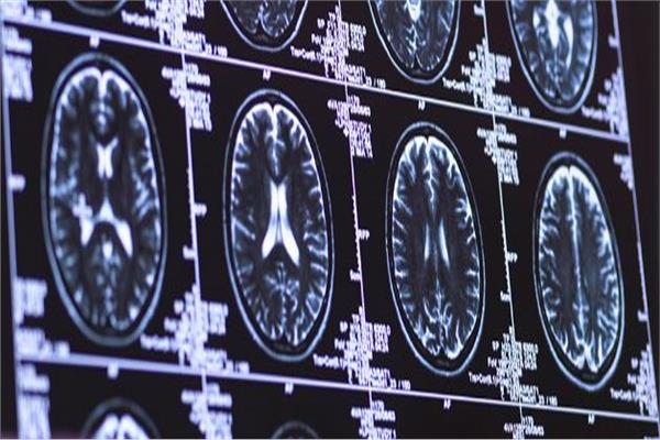 متغيرًا جينيًا يوفر حماية تصل إلى 70% ضد مرض الزهايمر