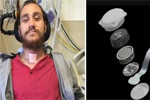 زرع «شريحة ماسك» لمريض ثانٍ