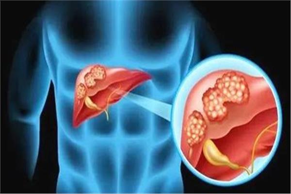 صورة تعبيرية لـ«دهون الكبد»