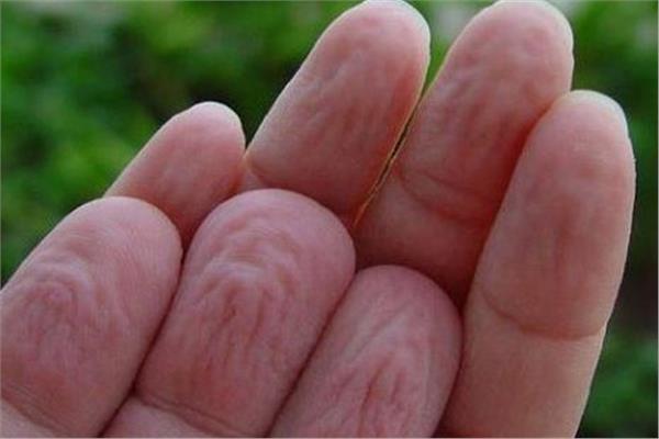 تجعد الأصابع