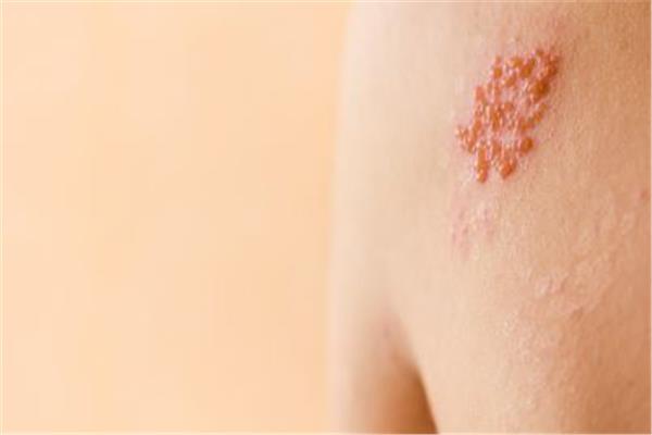 طرق الوقاية من مرض الحزام الناري؟