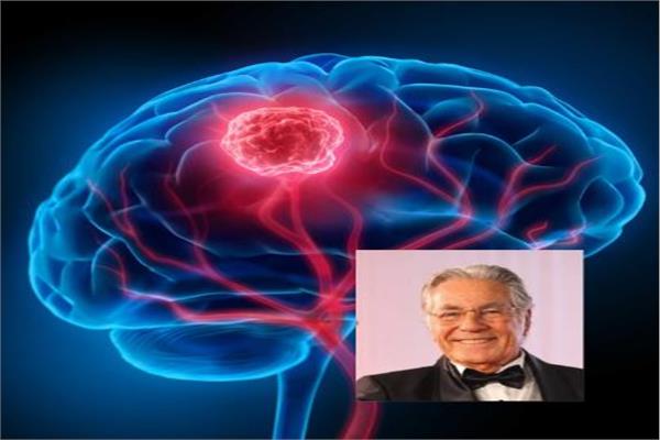 بعد وفاة حسين فهمي.. أعراض الإصابة بسرطان المخ 