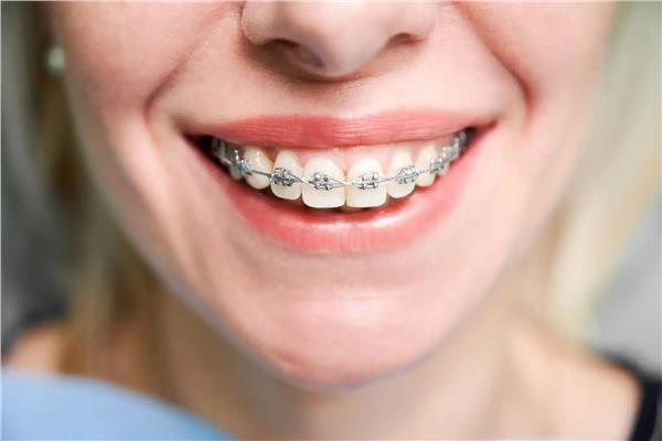 أجهزة التقويم لعلاج الأسنان