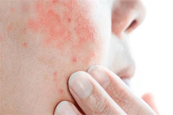 علاجات طبيعية لمنع الطفح الجلدي