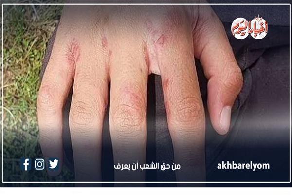 أعراض متلازمة فيكساس بعد ظهور أول حالة بمصر