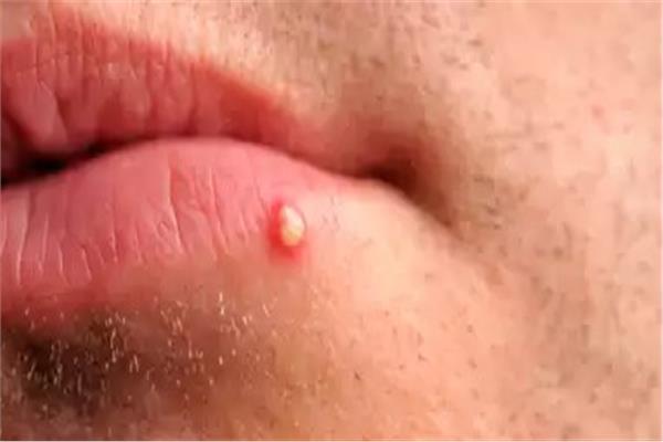 أسباب خطيرة للبثور البيضاء على الشفايف