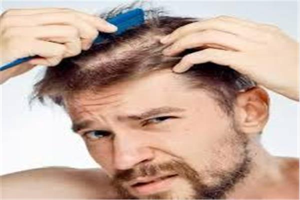تساقط الشعر