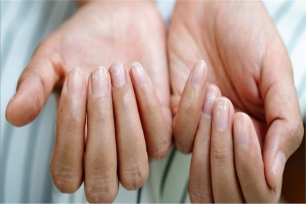 علامات تشير إلى نقص الفيتامينات