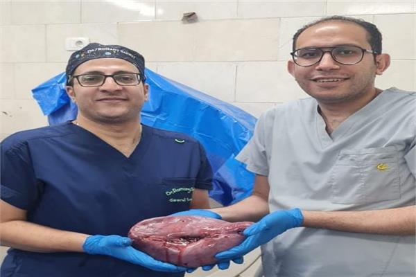 فريق طبي باستئصال طحال متضخم 