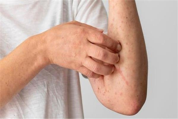 خطوات لتجنب الالتهابات الفطرية في الصيف