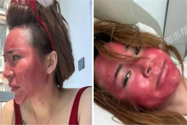 صينية تدفع ثمن الإهمال بوجه مشوه وحالة نفسية منهارة