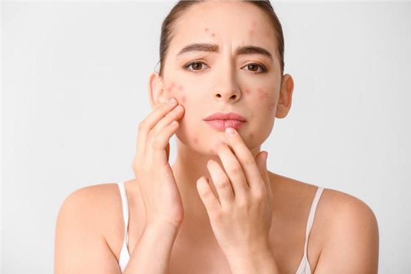 أطعمة تسبب في ظهور حب الشباب