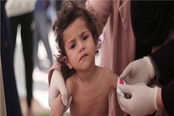 طفل في غزة تظهر عليه علامات سوء التغذية الحاد وفقدان الوزن بشكل كبير - أرشيفية