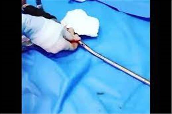 اختراق سيخ حديدي لذراعه الأيمن