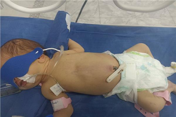 إنقاذ حياة طفلة رضيعة تعاني من انسداد معوي