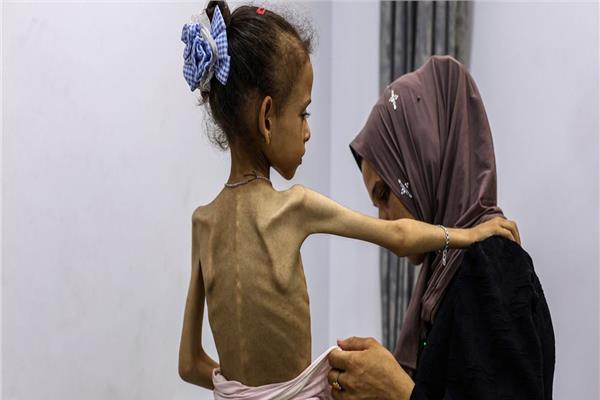 ارتفاع عدد ضحايا المجاعة وسوء التغذية 
