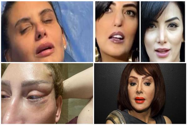 عمليات التجميل الفنانات