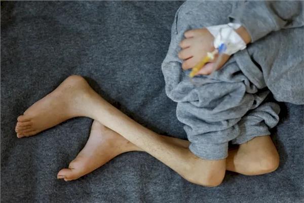 طفل في غزة يعاني من سوء التغذية - صورة أرشيفية