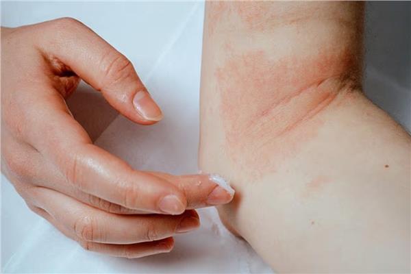 علاقة الإكزيما بالتفكير في إذاء النفس