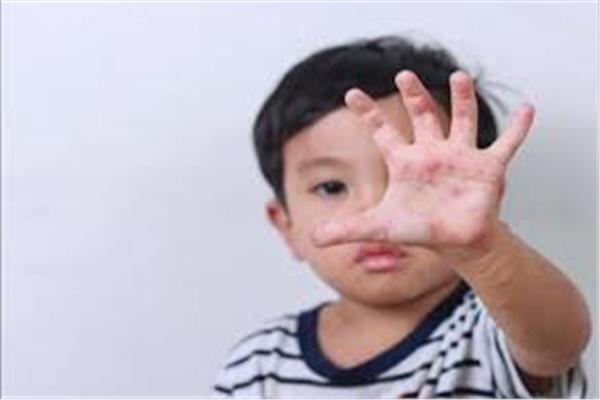  فيروس HFMD - صورة تعبيرية