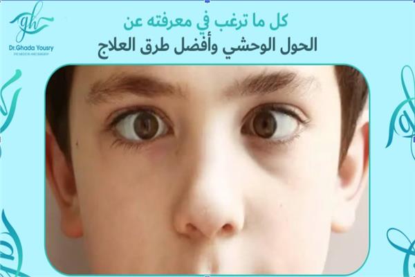 الحول الوحشي 