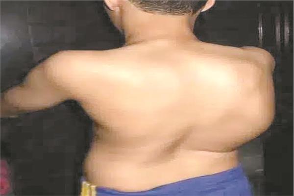 «الجنف» عدو الأطفال