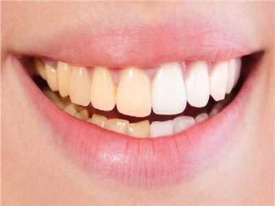 الصحة توضح.. أسباب اصفرار الأسنان