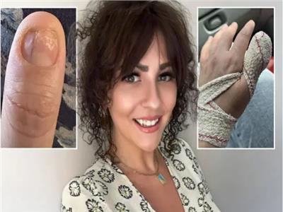 « الأكريليك والسرطان».. أم تكتشف علامة سرطان نادرة بعد إزالة أظافر الأكريليك