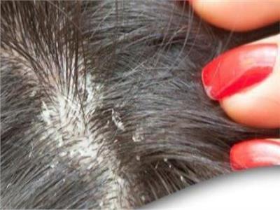 وصفات منزلية للتخلص من قشرة الشعر وتهدئة فروة الرأس