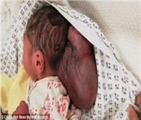 صور| عمره 3 سنوات.. طفل سوري يخضع لجراحة «الجمجمة المشقوقة»