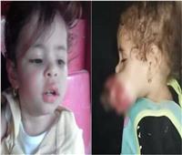 فيديو | «أنقذوا الطفلة مكة».. خطأ طبي سلب براءة وجهها