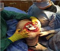 إجراء أول جراحة استبدال ركبة بمفصل صناعي بمستشفى الزرقا بدمياط