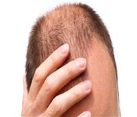 «طبيب تجميل» زراعة الشعر لم تعد تعالج مشاكل فروة الرأس فقط