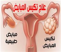 «طبيب نساء وتوليد»: الزيادة في الوزن أحد أسباب تكيس المبايض