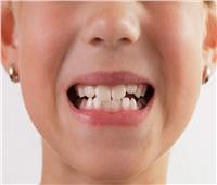 احذر.. العادات السيئة التي تضر بأسنان الأطفال
