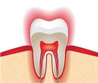  دكتور أسنان: هذه الحالات التى تحتاج الى سحب أو تمويت العصب