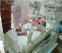 صور| ولادة طفل برأسين وقلب واحد في أسوان