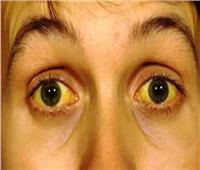 احذر.. تغيير لون بياض العين للأصفر يشير إلى مرض خطير 