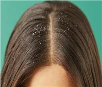 3 وصفات طبيعية للتخلص من «قشرة الشعر»